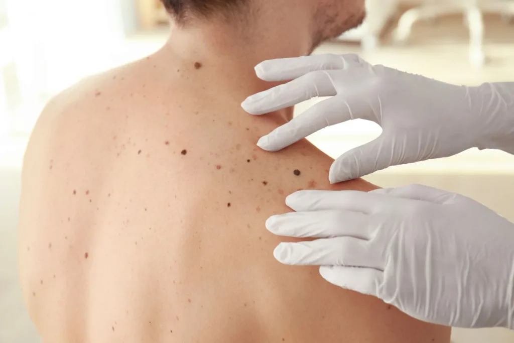 Skin Cancer Screenings & Removal in Mesa, AZ at Fox Dermatology and Aesthetics