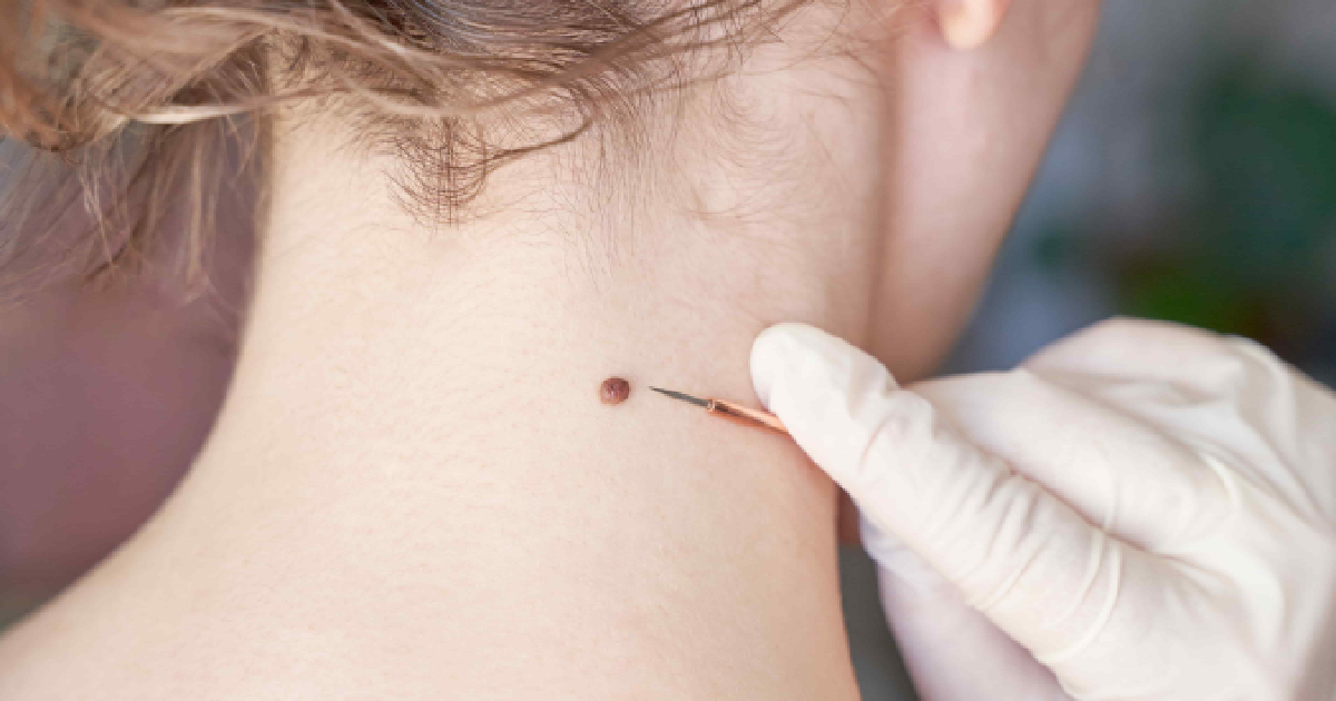 Close-up of a doctor performing Skin Cancer Screenings in Mesa, AZ, examining a dark brown, raised mole on a person’s neck with a gloved hand and pointed instrument.